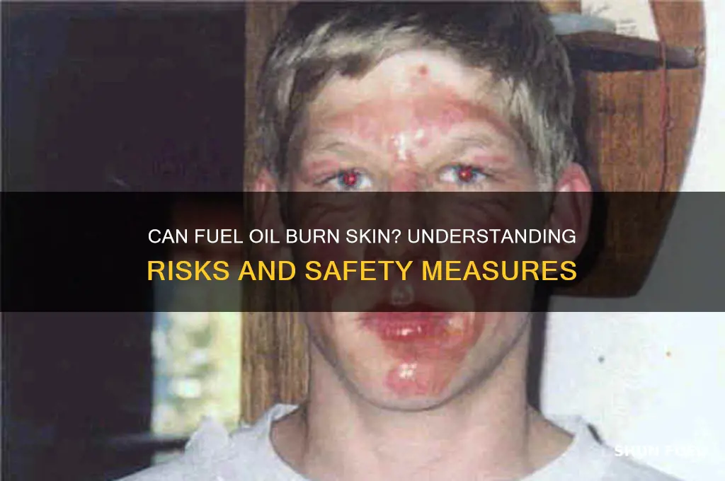 can fuel oil burn the zkin