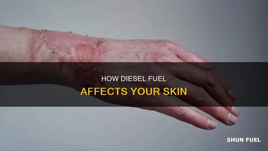 does diesel fuel burn skin