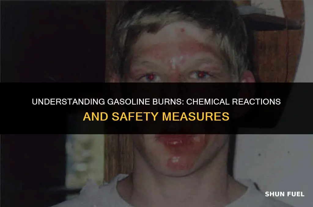 does gasoline cause a chemical burn