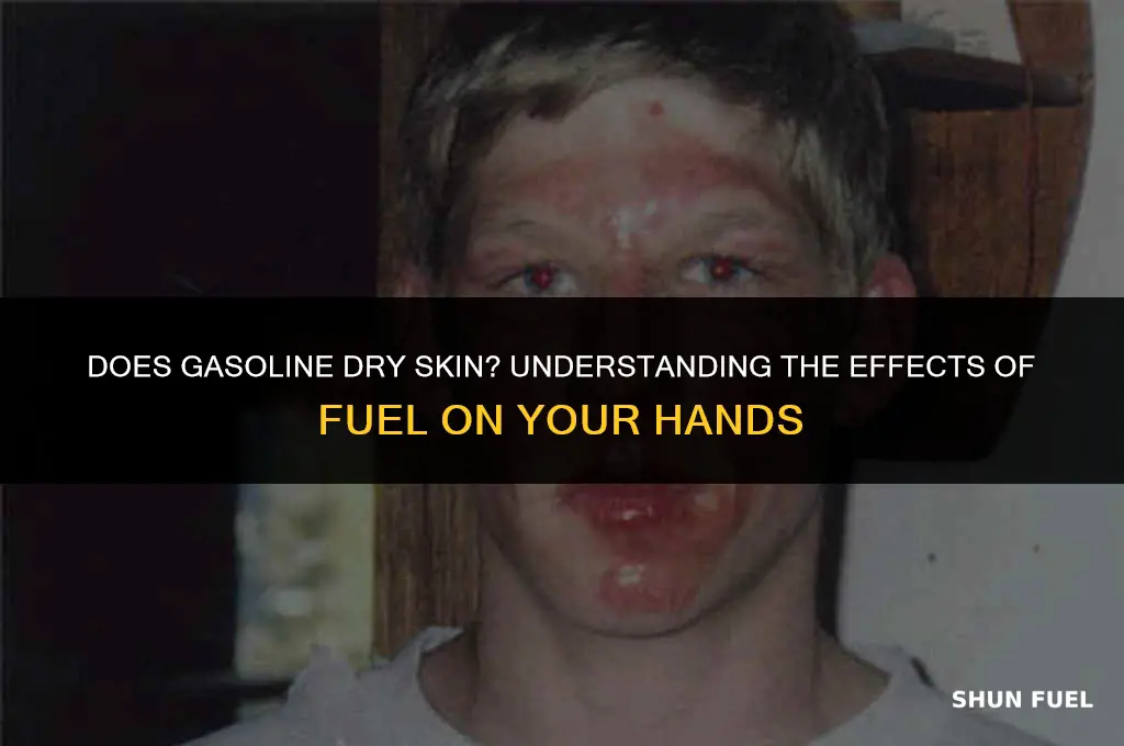 does gasoline dry skin