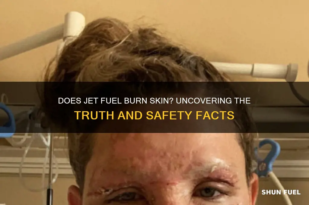does jet fuel burn skin